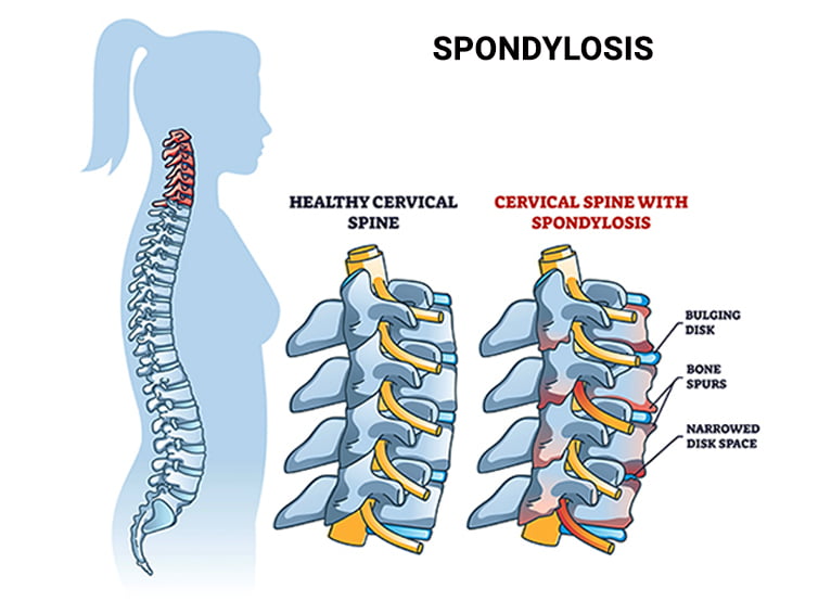 Spondylosis gerincelváltozást ábrázoló orvosi illusztráció – kopott porckorongok és meszesedett csigolyák a nyaki és ágyéki szakaszon.